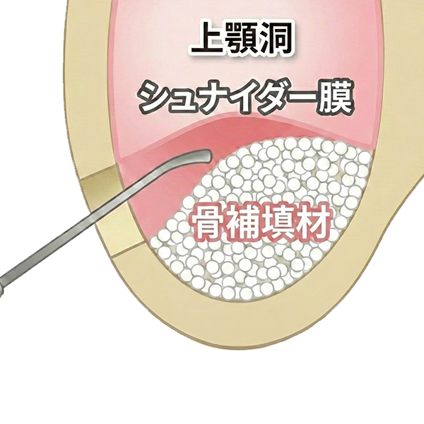 山形市の骨造成で対応する難症例のインプラント治療なら永田歯科医院
