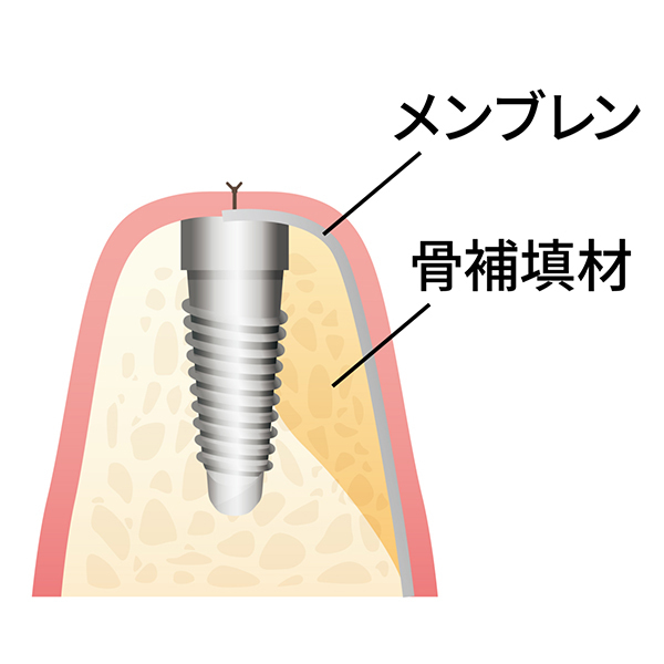 山形市の骨造成で対応する難症例のインプラント治療なら永田歯科医院