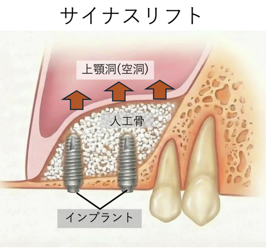 インプラント治療 - 永田歯科院（南山形・山形市）